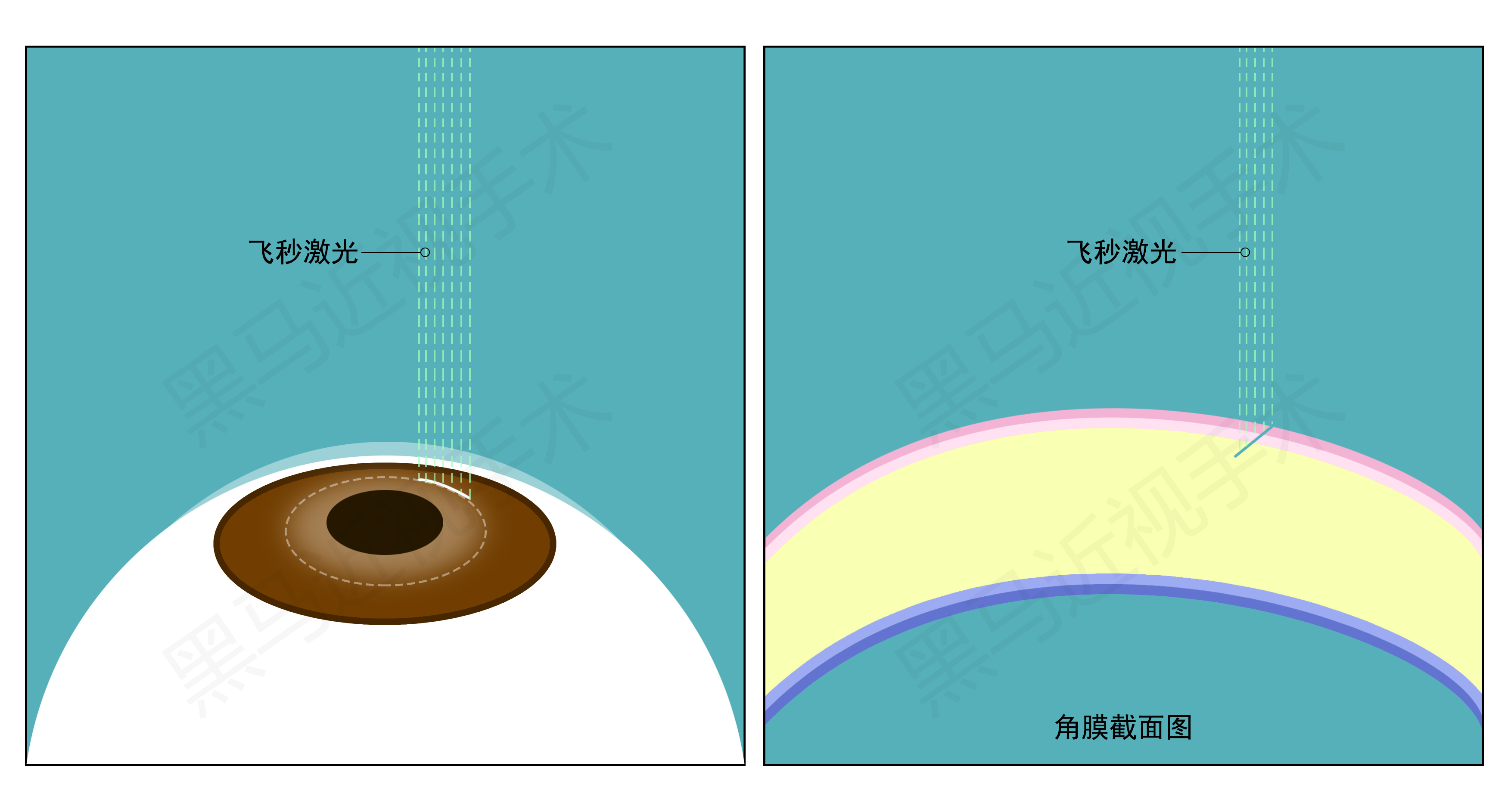 “全飞秒制瓣”/ 黑马眼科